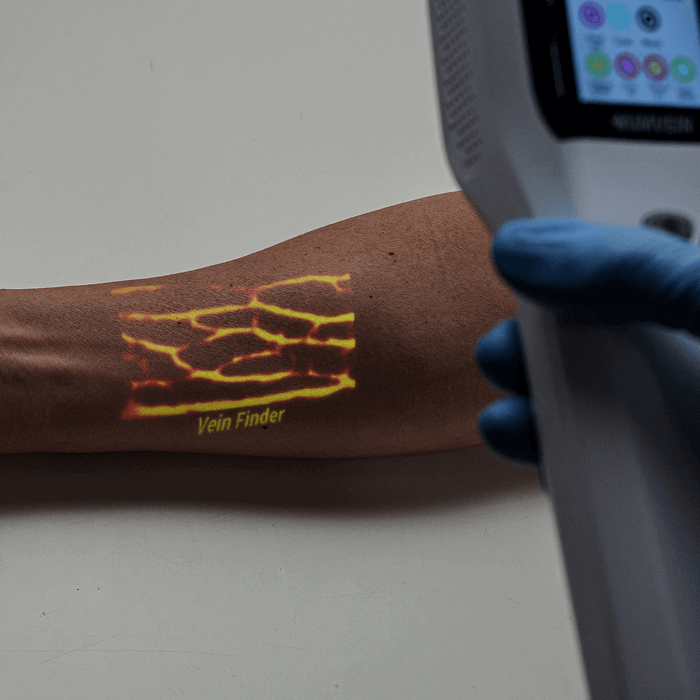 fine-details-of-vein-imaging-in-arm-with-aimvein-pro-30